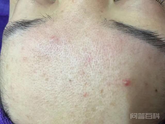 你是怎么处理好自己的青春痘或痘印的?-图片5