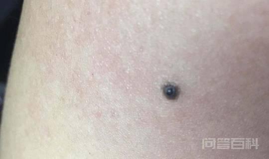 痦子和痣有什么区别?什么样的痣不能点?别把它当成痦子给去掉-图片1