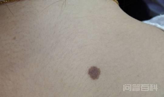 痦子和痣有什么区别?什么样的痣不能点?别把它当成痦子给去掉-图片2