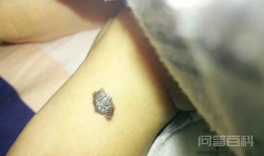 痦子和痣有什么区别?什么样的痣不能点?别把它当成痦子给去掉-图片3