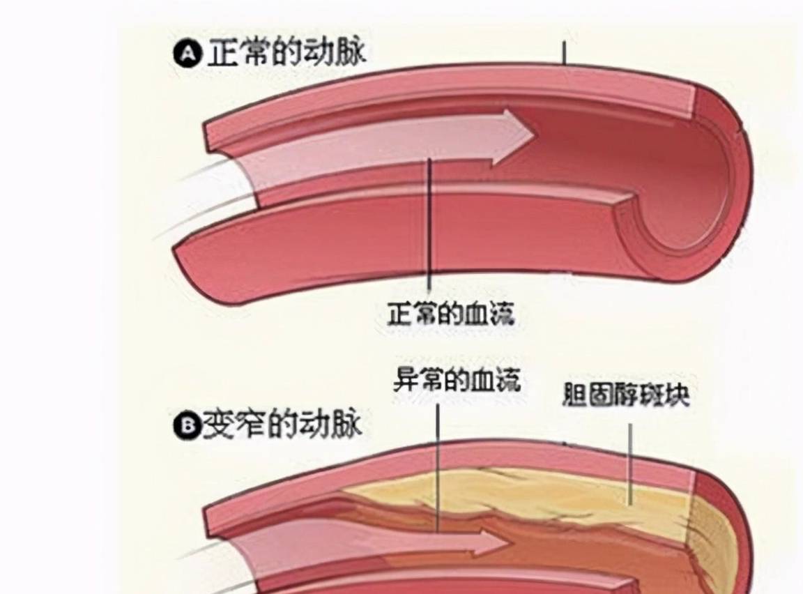 近一半高血压患者也有高尿酸，这两者有什么关系？治疗有何区别？