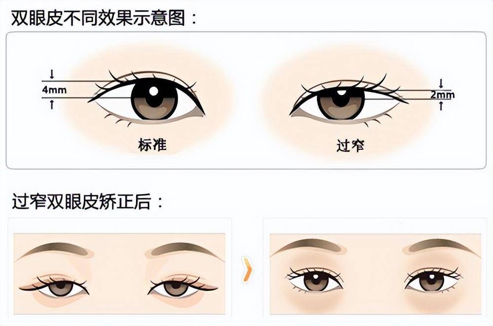 双眼皮术后10天效果图，术后10天效果图，眼睛有神