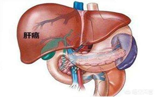 原发性肝癌是什么意思 原发性肝癌