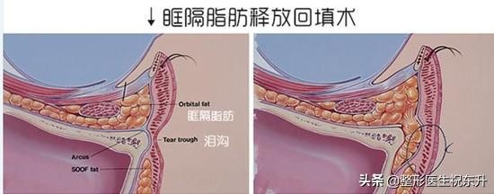  眼带太大怎么办 眼袋大是什么原因造成的