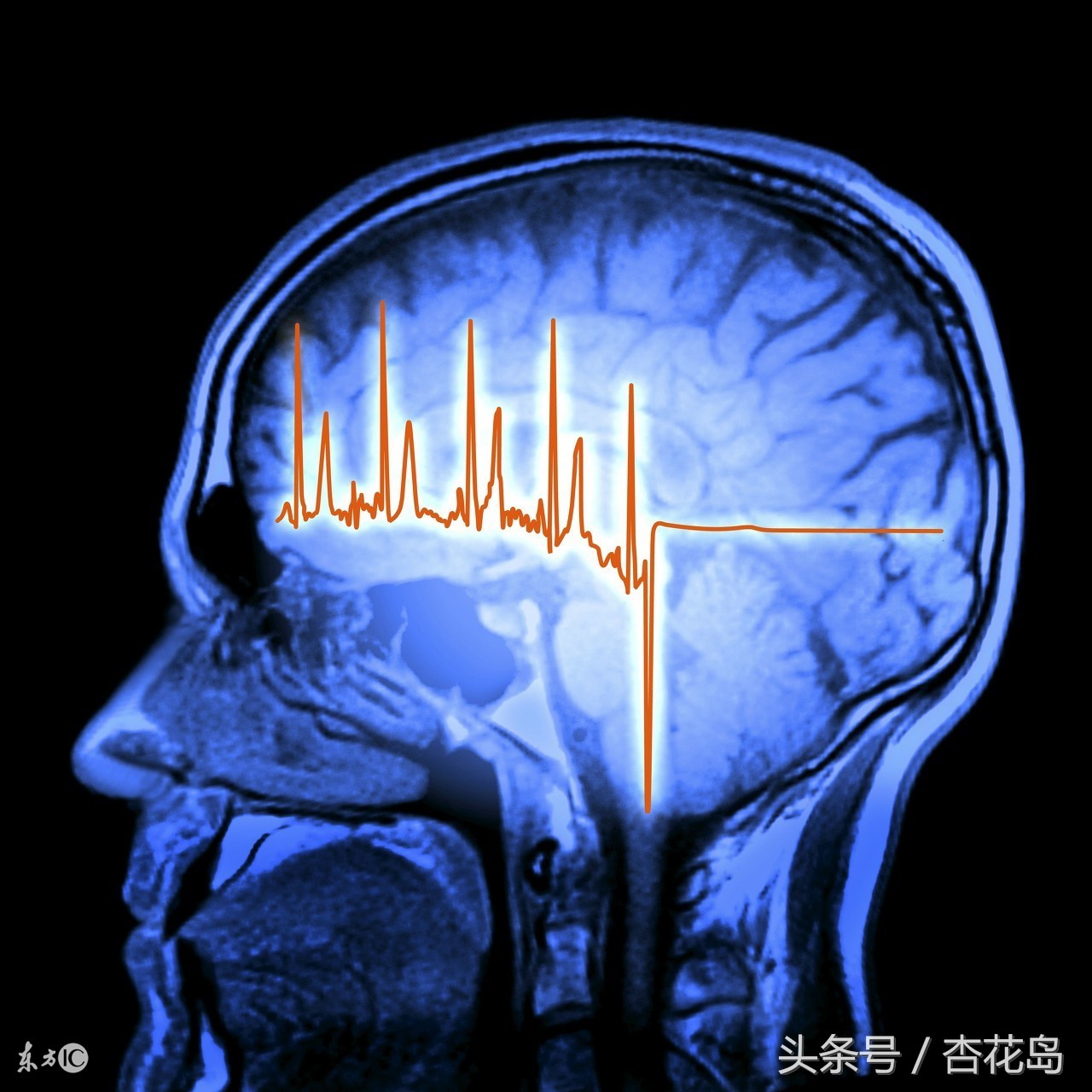 年轻人也会突发性的中风吗 头发没干骑车成面瘫