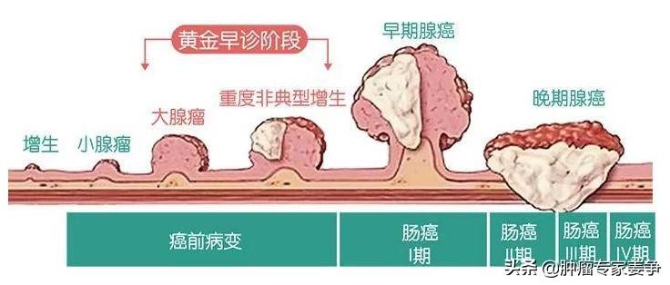 浙江一17岁学生确诊肠癌 17岁学生确诊肠癌