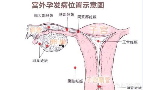 怀孕怎么打胎 打胎的危害是什么