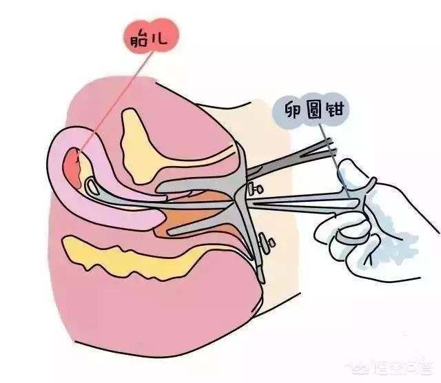 怀孕怎么打胎 打胎的危害是什么