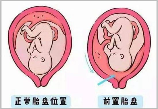 【科普】解除孕妇担心：早孕期超声提示胎盘位置低怎么办