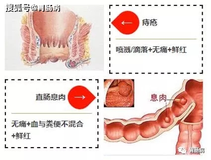 血便和便血的区别图片_血便图片_血便